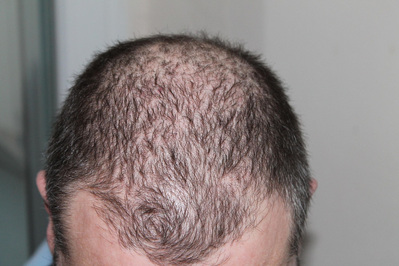 chemotherapy hair loss